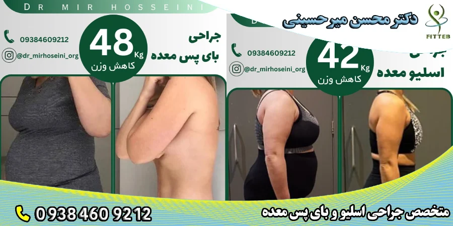 بهترین جراح چاقی در تهران- دکتر میر حسینی